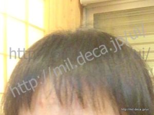 免疫調整剤「イムラン」副作用、脱毛