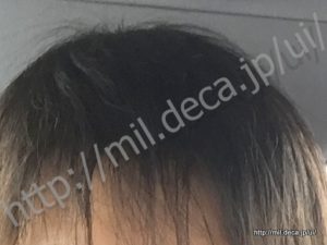 免疫調整剤「イムラン」副作用、脱毛から元に戻った状態