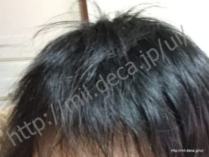 免疫調整剤「イムラン」副作用、脱毛から元に戻った状態