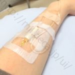 レミケード2日目、潰瘍性大腸炎