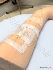 レミケード2日目、潰瘍性大腸炎