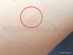 レミケード2日目、潰瘍性大腸炎