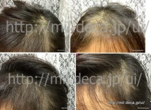 免疫調整剤「イムラン」副作用、脱毛